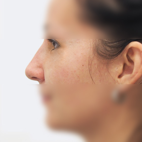 Klientka před a po plastické operaci nosu, foceno 3 měsíce po zákroku.
Operatér: MUDr. Peter Ondrejka