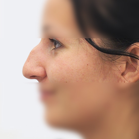 Klientka před a po plastické operaci nosu, foceno 3 měsíce po zákroku.
Operatér: MUDr. Peter Ondrejka