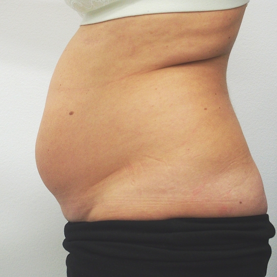 Klientka před a po ultrazvukové liposukci břicha. Odsáto 1600ml. tuku. foceno 2 měsíce po zákroku.
Operatér: MUDr. Peter Ondrejka