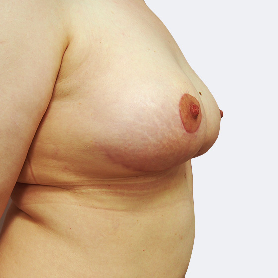 Klientka před a po modelaci prsou středního rozsahu (při poklesu poprsí), foceno 8 týdnů po zákroku.
Operatér: MUDr. Martin Fiala
