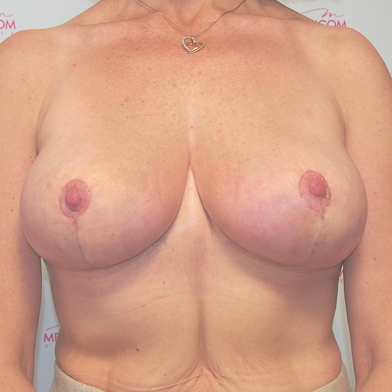 Klientka před a po modelaci prsou, foceno 7 týdnů po zákroku.
Operatér: MUDr. Martin Fiala