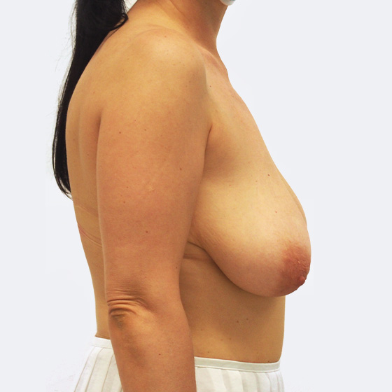 Klientka před a po modelaci poprsí středního rozsahu (při poklesu poprsí) s redukcí pravého prsu. Foceno 6 týdnů po zákroku.
Operatér: MUDr. Michal Puls, CSc.