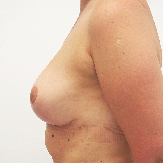 Klientka před a po modelace prsou s malou redukcí. Foceno 3 měsíce po zákroku.
Operatér: MUDr. Petros Christodoulou