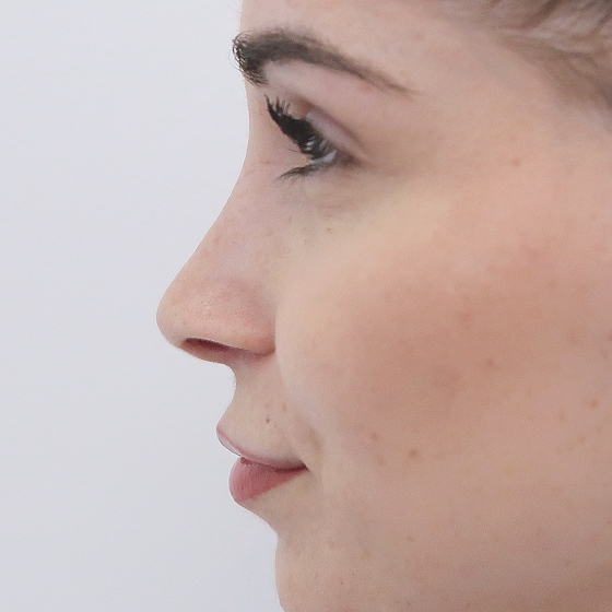 Klientka před a po plastické operaci nosu - kompletní rinoseptoplastika (úprava zevního nosu vč. korekce nosní přepážky). Foceno 1 měsíc po zákroku.
Operatér: MUDr. Tomáš Nedeliak