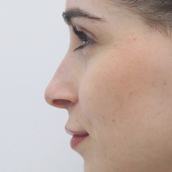 Klientka před a po plastické operaci nosu - kompletní rinoseptoplastika (úprava zevního nosu vč. korekce nosní přepážky). Foceno 1 měsíc po zákroku.
Operatér: MUDr. Tomáš Nedeliak