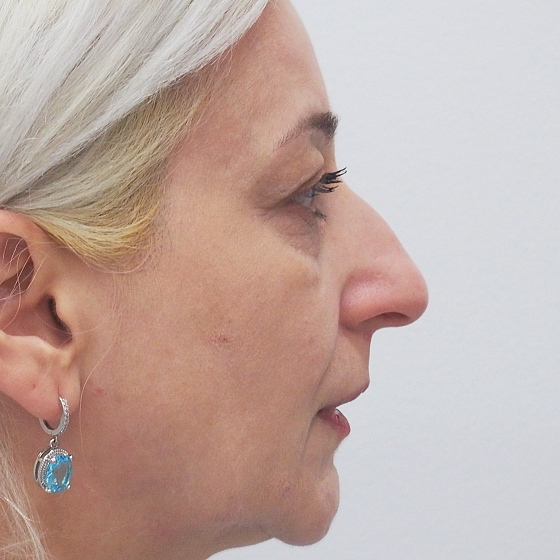Klientka před a po plastické operaci nosu - kompletní rinoseptoplastika (úprava zevního nosu vč. korekce nosní přepážky). foceno 1 měsíc po zákroku.
Operatér: MUDr. Tomáš Nedeliak