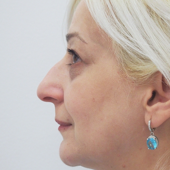 Klientka před a po plastické operaci nosu - kompletní rinoseptoplastika (úprava zevního nosu vč. korekce nosní přepážky). foceno 1 měsíc po zákroku.
Operatér: MUDr. Tomáš Nedeliak