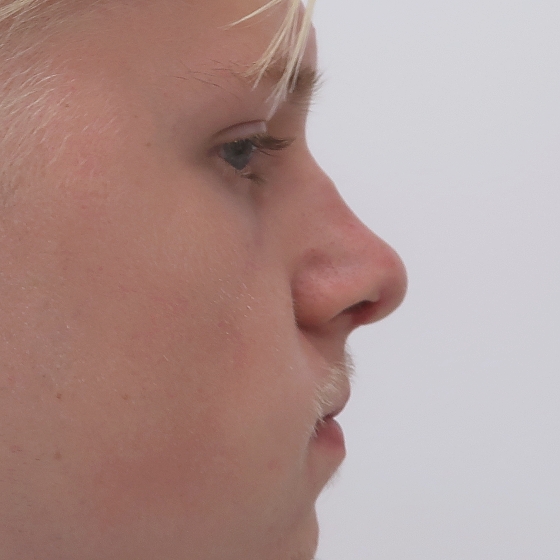 Klientka před a po plastické operaci nosu - kompletní rinoseptoplastika (úprava zevního nosu vč. korekce nosní přepážky). Foceno 2 měsíce po zákroku.
Operatér: MUDr. Tomáš Nedeliak