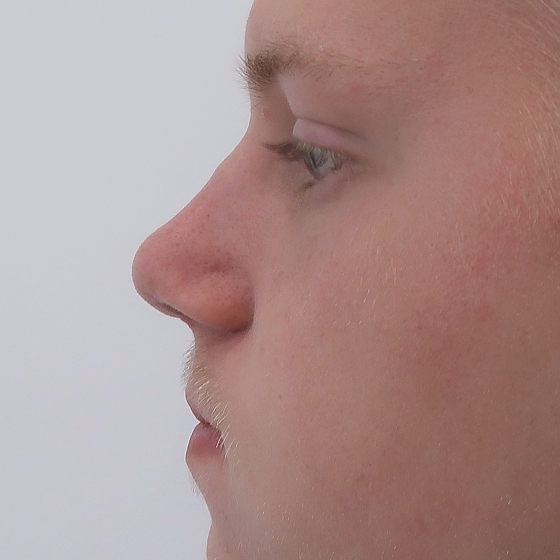 Klientka před a po plastické operaci nosu - kompletní rinoseptoplastika (úprava zevního nosu vč. korekce nosní přepážky). Foceno 2 měsíce po zákroku.
Operatér: MUDr. Tomáš Nedeliak