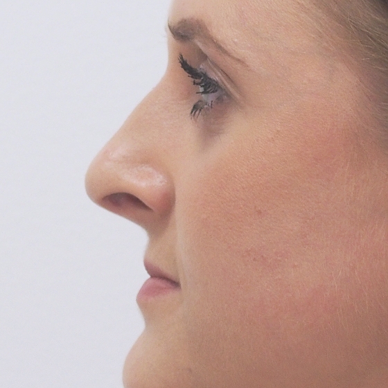 Klientka před a po plastické operaci nosu - rhinoplastice (úprava zevního nosu).
Operatér: MUDr. Tomáš Nedeliak