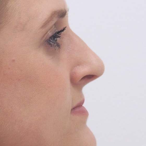 Klientka před a po plastické operaci nosu - rhinoplastice (úprava zevního nosu).
Operatér: MUDr. Tomáš Nedeliak
