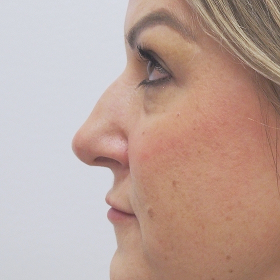 Klientka před a po plastické operaci nosu - kompletní rinoseptoplastika (úprava zevního nosu vč. korekce nosní přepážky). Foceno 4 měsíce po zákroku.
Operatér: MUDr. Tomáš Nedeliak