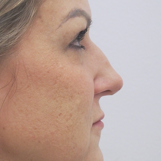 Klientka před a po plastické operaci nosu - kompletní rinoseptoplastika (úprava zevního nosu vč. korekce nosní přepážky). Foceno 4 měsíce po zákroku.
Operatér: MUDr. Tomáš Nedeliak