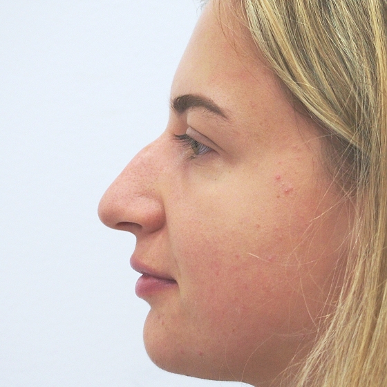 Klientka před a po plastické operaci nosu, foceno 2 měsíce po zákroku.
Operatér: MUDr. Peter Ondrejka