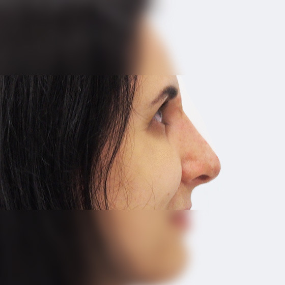 Klientka před a po plastické operaci nosu, foceno 6 týdnů po zákroku.
Operatér: MUDr. Peter Ondrejka