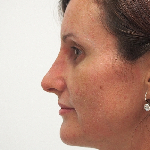 Klientka před a po plastické operaci nosu, foceno 2 měsíce po zákroku.
Operatér: MUDr. Peter Ondrejka