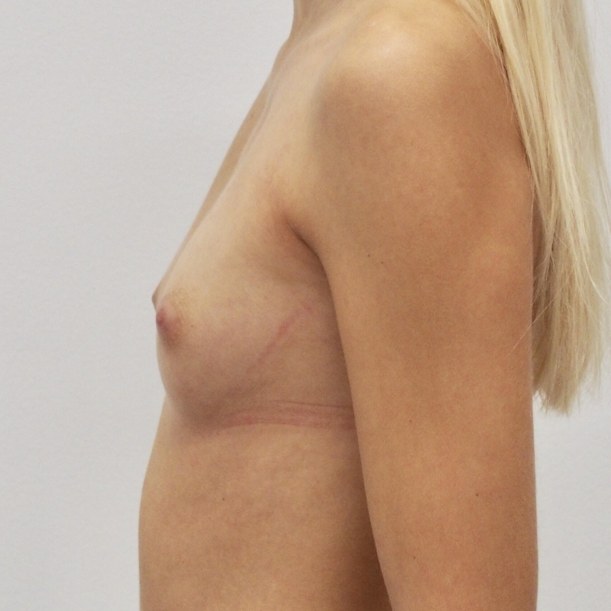 Klientka před a po zvětšení prsou. Použity byly kulaté implantáty o velikosti 255 mililitrů. Vloženy byly podprsní rýhou pod sval.
Operatér: MUDr. Petros Christodoulou