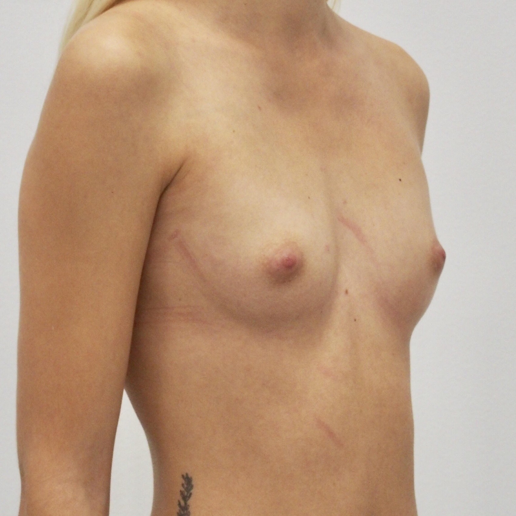 Klientka před a po zvětšení prsou. Použity byly kulaté implantáty o velikosti 255 mililitrů. Vloženy byly podprsní rýhou pod sval.
Operatér: MUDr. Petros Christodoulou