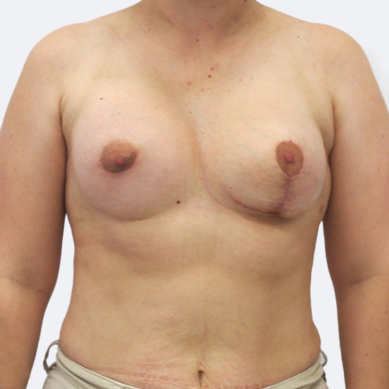 Klientka před a po zvětšení prsou s jednostrannou modelací. Použity byly polyuretanové implantáty o velikosti 180 a 290 mililitrů. 
Operatér: MUDr. Petros Christodoulou