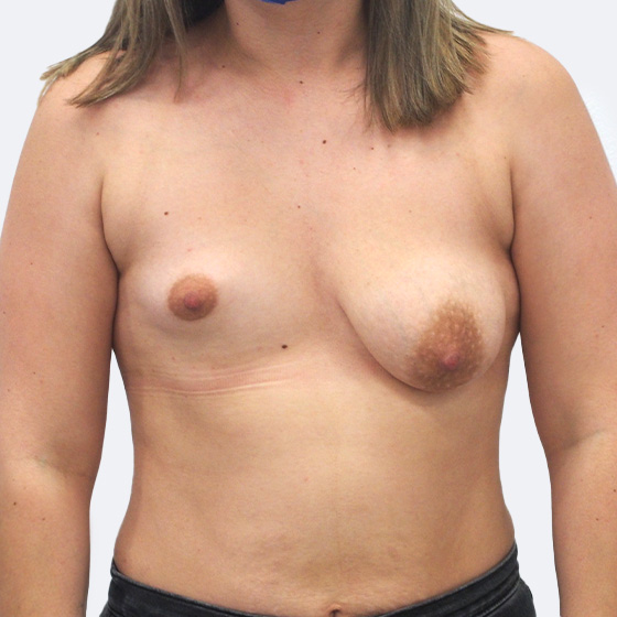 Klientka před a po zvětšení prsou s jednostrannou modelací. Použity byly polyuretanové implantáty o velikosti 180 a 290 mililitrů. 
Operatér: MUDr. Petros Christodoulou