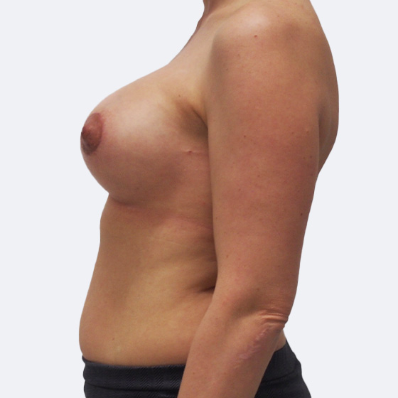 Klientka před a po zvětšení prsou s jednostrannou modelací. Použity byly anatomické implantáty o velikosti 235 a 360 mililitrů.
Operatér: MUDr. Petros Christodoulou