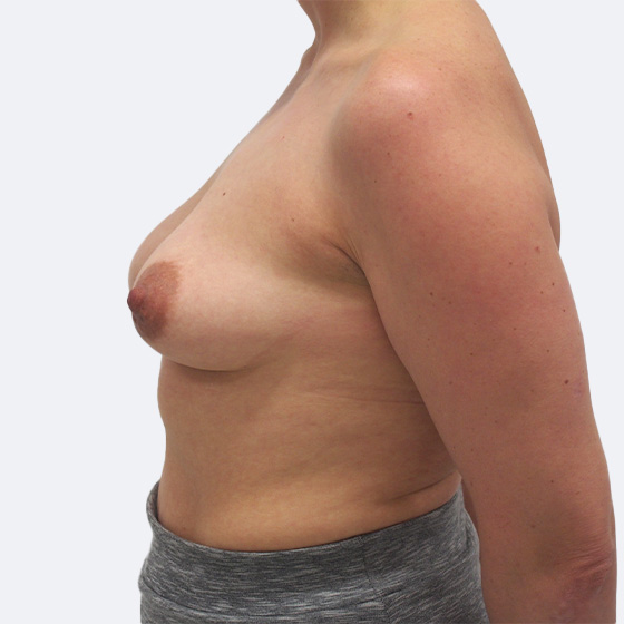 Klientka před a po zvětšení prsou s jednostrannou modelací. Použity byly anatomické implantáty o velikosti 235 a 360 mililitrů.
Operatér: MUDr. Petros Christodoulou