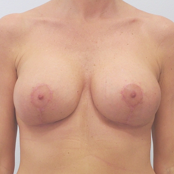 Klientka před a po zvětšení prsou s modelací. Použity byly kulaté implantáty o velikosti 300 mililitrů. 
Operatér: Prim. MUDr. Pavel Horyna