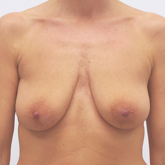 Klientka před a po zvětšení prsou s modelací. Použity byly kulaté implantáty o velikosti 300 mililitrů. 
Operatér: Prim. MUDr. Pavel Horyna