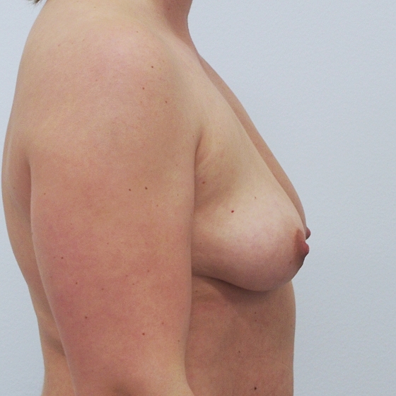 Klientka před a po zvětšení prsou. Použity byly kulaté implantáty o velikosti 400 mililitrů. Vloženy byly podprsní rýhou pod sval.
Operatér: MUDr. Peter Ondrejka
