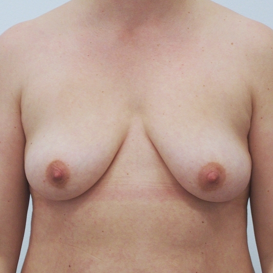 Klientka před a po zvětšení prsou. Použity byly kulaté implantáty o velikosti 400 mililitrů. Vloženy byly podprsní rýhou pod sval.
Operatér: MUDr. Peter Ondrejka