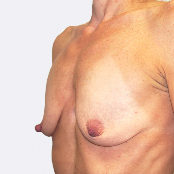 Klientka před a po zvětšení prsou s modelací. Použity byly kapkovité implantáty o velikosti 390 mililitrů. 
Operatér: Prim. MUDr. Petr Pachman