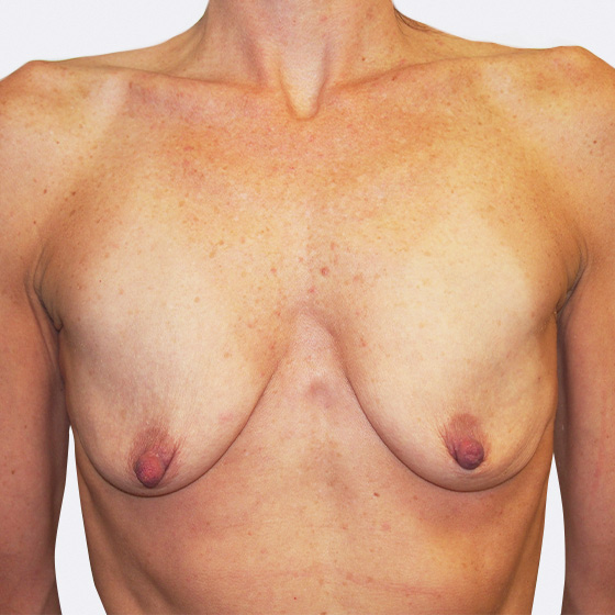 Klientka před a po zvětšení prsou s modelací. Použity byly kapkovité implantáty o velikosti 390 mililitrů. 
Operatér: Prim. MUDr. Petr Pachman