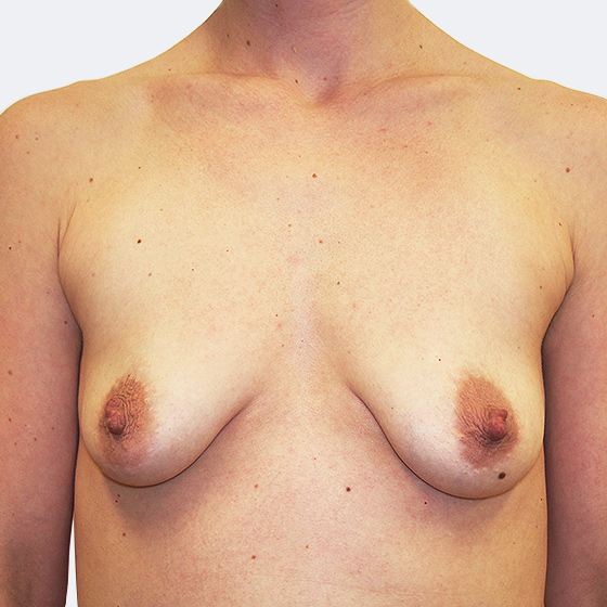 Klientka před a po zvětšení prsou s modelací. Použity byly anatomické implantáty o velikosti 375 mililitrů. Vloženy byly podprsní rýhou pod sval.
Operatér: Prim. MUDr. Petr Pachman