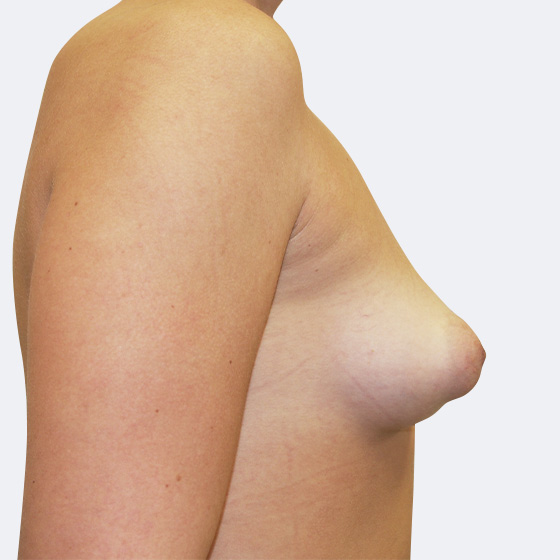 Klientka před a po zvětšení prsou s modelací. Použity byly kapkovité implantáty o velikosti 300 mililitrů. 
Operatér: Prim. MUDr. Petr Pachman