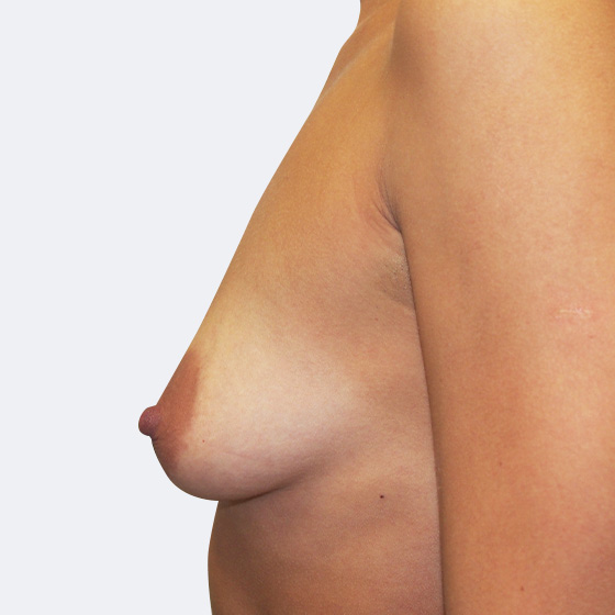 Klientka před a po zvětšení prsou s modelací. Použity byly anatomické implantáty o velikosti 260 mililitrů. 
Operatér: Prim. MUDr. Petr Pachman