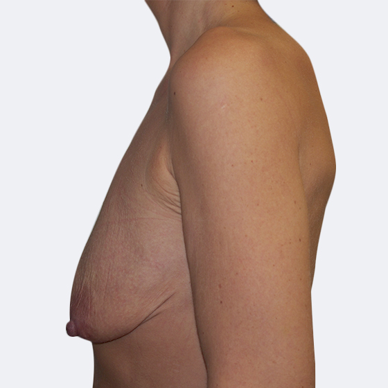 Klientka před a po zvětšení prsou s modelací. Použity byly kulaté implantáty o velikosti 350 mililitrů. 
Operatér: Prim. MUDr. Petr Pachman
