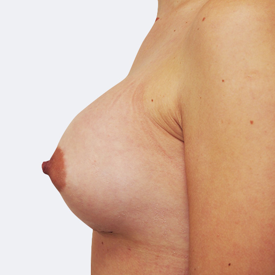 Klientka před a po zvětšení prsou s modelací. Použity byly kulaté implantáty o velikosti 300 a 350 mililitrů. 
Operatér: Prim. MUDr. Petr Pachman