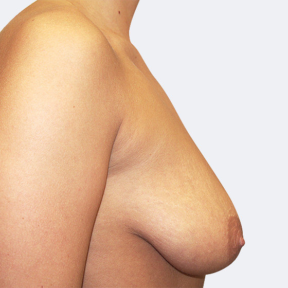 Klientka před a po zvětšení prsou s modelací. Použity byly kapkovité implantáty o velikosti 345 mililitrů. 
Operatér: Prim. MUDr. Petr Pachman