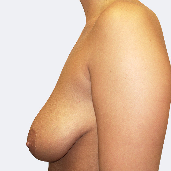 Klientka před a po zvětšení prsou s modelací. Použity byly kapkovité implantáty o velikosti 345 mililitrů. 
Operatér: Prim. MUDr. Petr Pachman