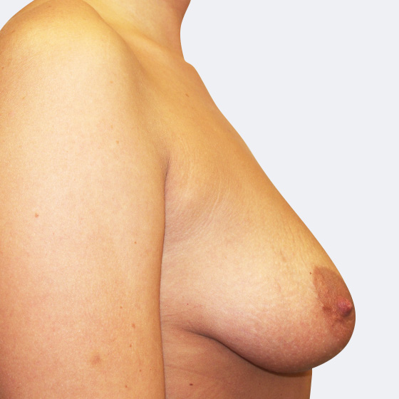 Klientka před a po zvětšení prsou s modelací. Použity byly kulaté implantáty o velikosti 300 a 275 mililitrů. 
Operatér: Prim. MUDr. Petr Pachman