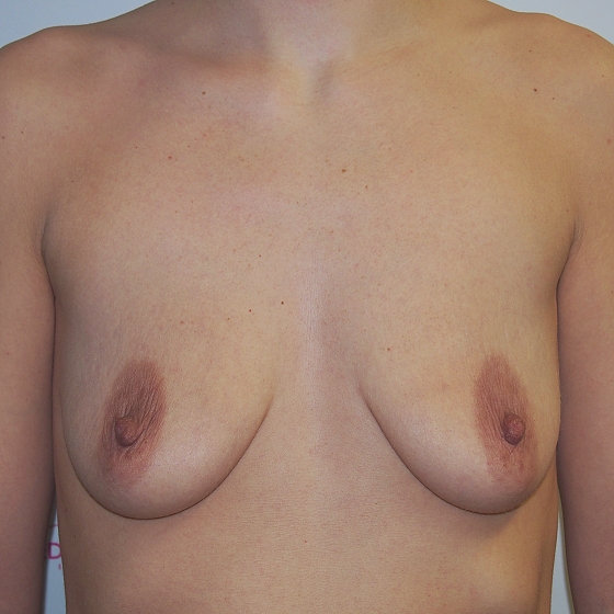 Klientka před a po zvětšení prsou s modelací. Použity byly kulaté implantáty o velikosti 375 mililitrů. 
Operatér: Prim. MUDr. Petr Pachman