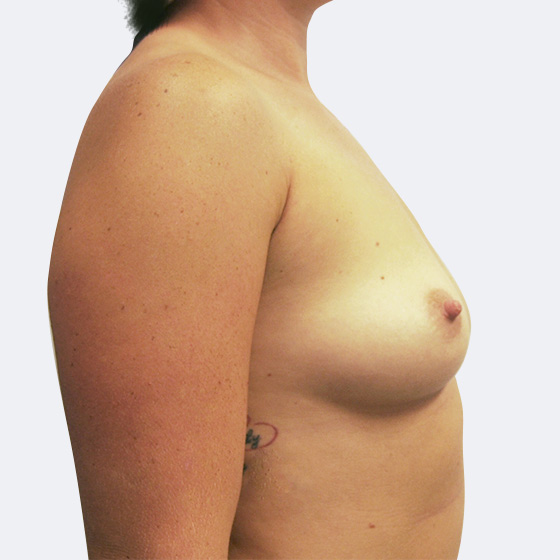 Klientka před a po zvětšení prsou. Použity byly kulaté implantáty o velikosti 375 mililitrů, vysoký profil. Vloženy byly podprsní rýhou pod sval.
Operatér: MUDr. Martin Fiala