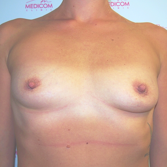 Klientka před a po zvětšení prsou. Použity byly kulaté implantáty o velikosti 450 mililitrů, vysoký profil. Vloženy byly podprsní rýhou pod sval.
Operatér: MUDr. Martin Fiala