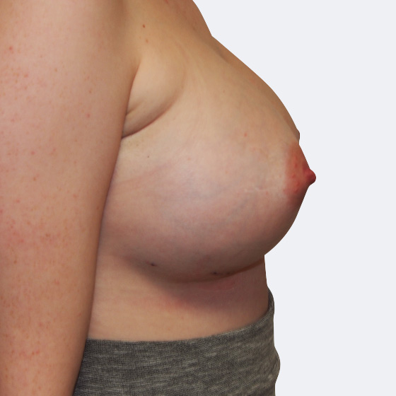 Klientka před a po zvětšení prsou. Použity byly kulaté implantáty o velikosti 400 mililitrů, vysoký profil. Vloženy byly podprsní rýhou pod sval.
Operatér: MUDr. Martin Fiala