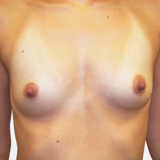 Klientka před a po zvětšení prsou. Použity byly kulaté implantáty o velikosti 275 mililitrů, vysoký profil. Vloženy byly podprsní rýhou pod sval.
Operatér: MUDr. Martin Fiala