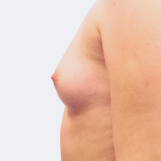 Klientka před a po zvětšení prsou. Použity byly kulaté implantáty o velikosti 300 mililitrů, vysoký profil. Vloženy byly podprsní rýhou pod sval.
Operatér: MUDr. Martin Fiala