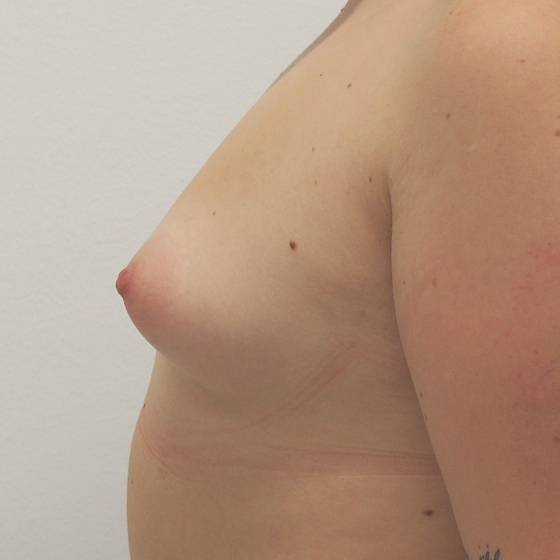 Klientka před a po augmentaci tuberózních prsou. Použity byly kulaté implantáty o velikosti 270 mililitrů. 
Operatér: Prim. MUDr. Pavel Horyna