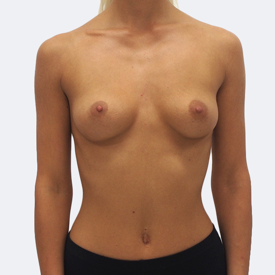 Klientka před a po zvětšení prsou. Použity byly kulaté implantáty o velikosti 375 mililitrů. Vloženy byly podprsní rýhou pod sval.
Operatér: Prim. MUDr. Pavel Horyna