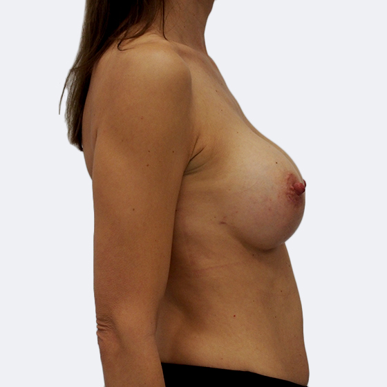 Klientka před a po zvětšení prsou. Použity byly kulaté implantáty o velikosti 315 mililitrů. Vloženy byly podprsní rýhou pod sval.
Operatér: Prim. MUDr. Pavel Horyna