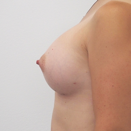 Klientka před a po zvětšení prsou. Použity byly kulaté implantáty o velikosti 450 mililitrů. Vloženy byly podprsní rýhou pod sval.
Operatér: Prim. MUDr. Pavel Horyna